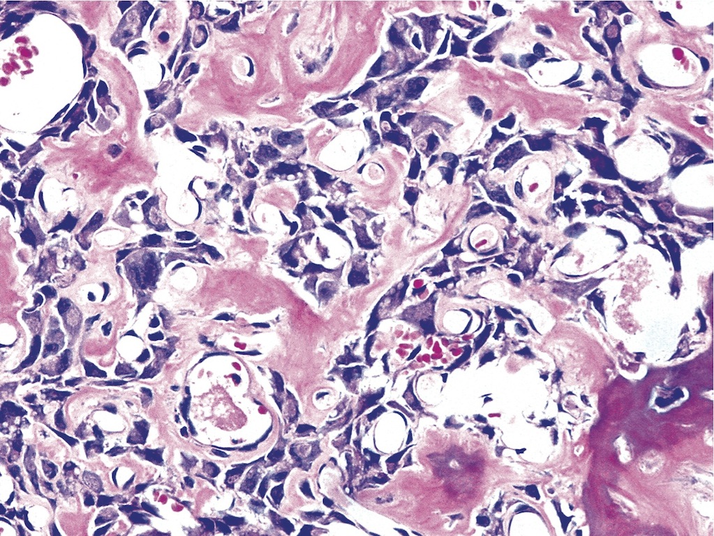 Pathology Outlines Osteoblastoma 3401